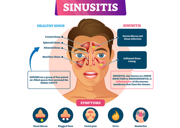 Here Are 9 Ways to Get Rid of a Sinus Infection, Plus Tips for Prevention